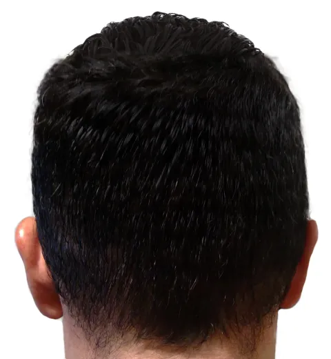 Donor hair after No-Shave FUE