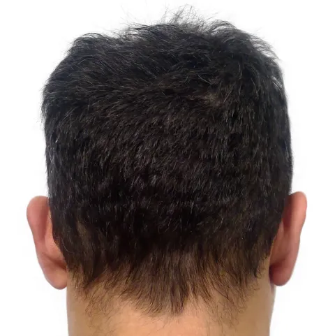 Donor hair before No-Shave FUE