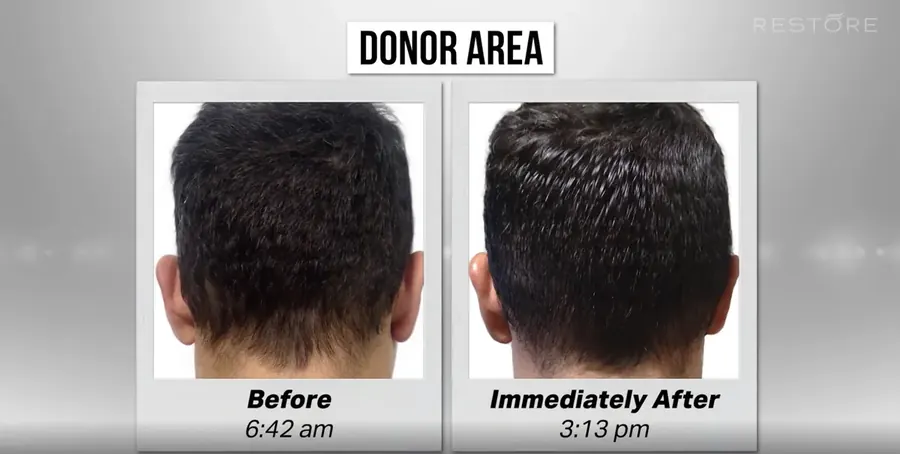 RESTORE No-Shave FUE procedure