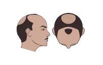 Norwood Class 5 hair loss illustration