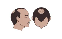 Norwood Class 4 hair loss illustration