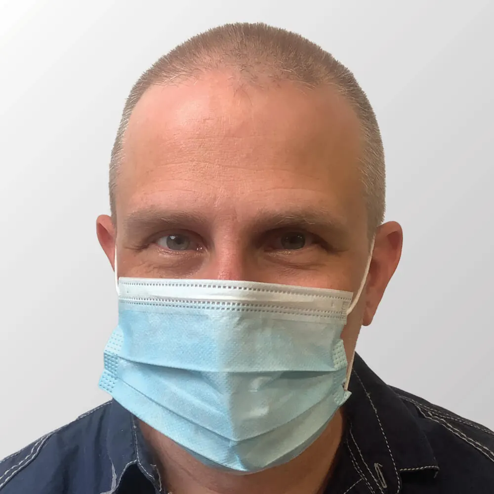 Kevin B. before hair transplant